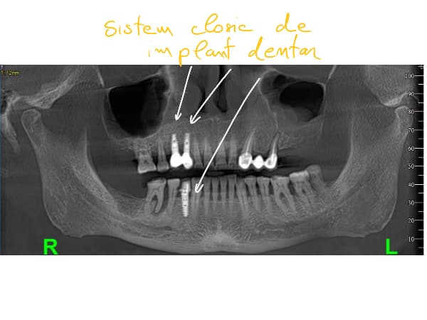 Implant dentar dr durbac
