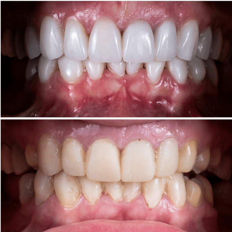 Fațete Pentru Dinți: O Soluție Estetică Pentru O Dantură Perfectă Fațete Dentare