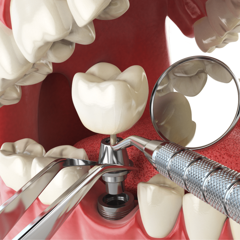 Operatie Implant dentar