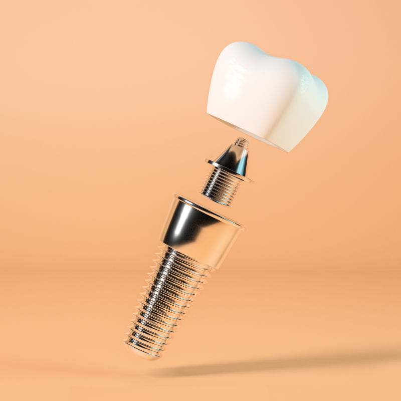 Variante Implant Dentar