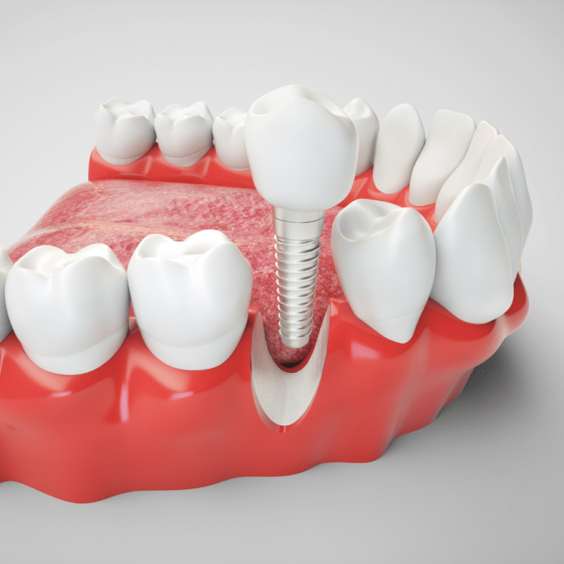 Costuri Implant Dentar