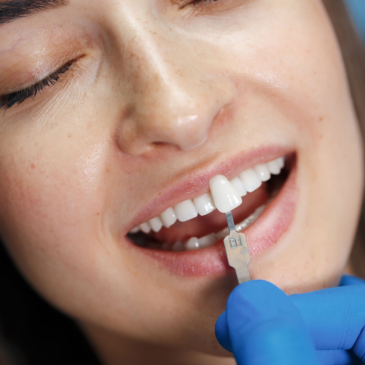 Aparat dentar vs Fatete